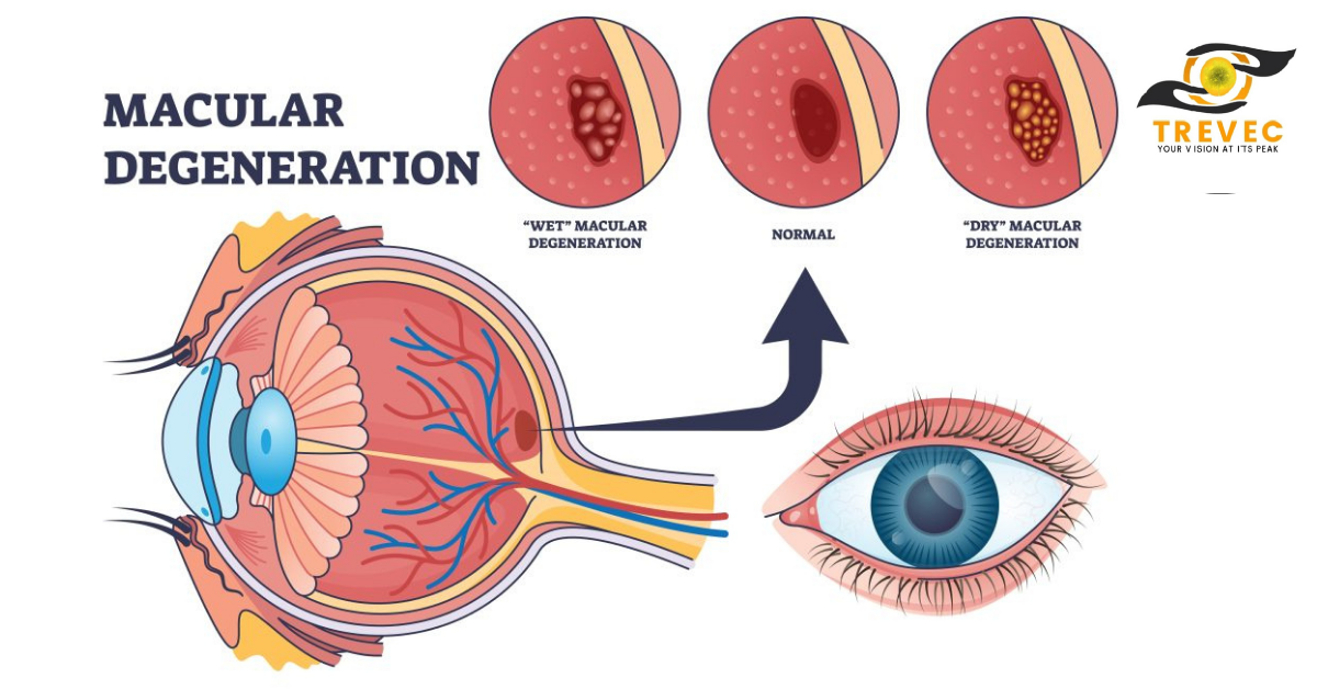 macular degeneration