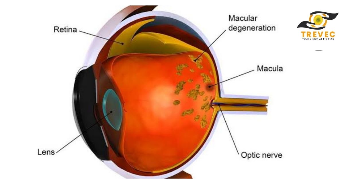 macular degeneration