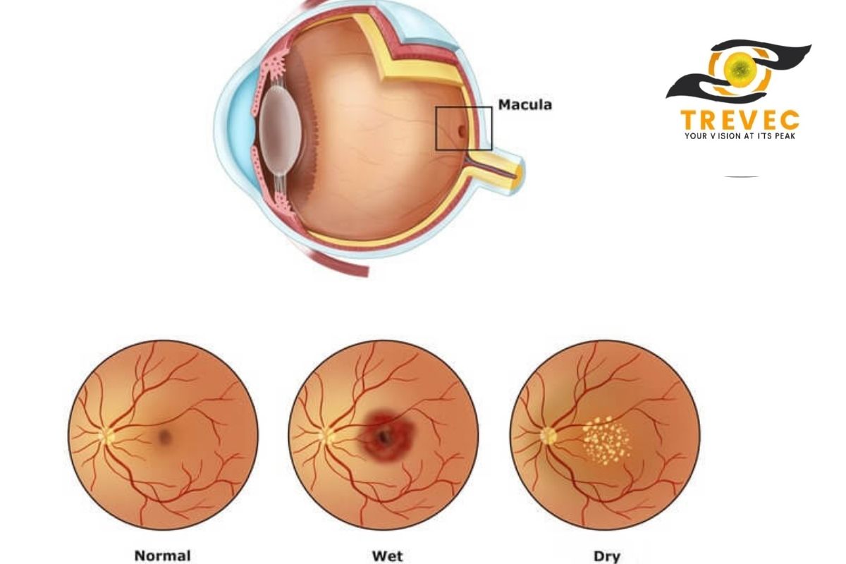 macular degeneration