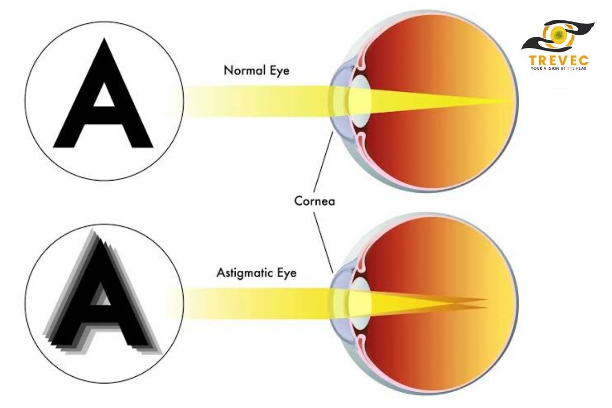 Astigmatism