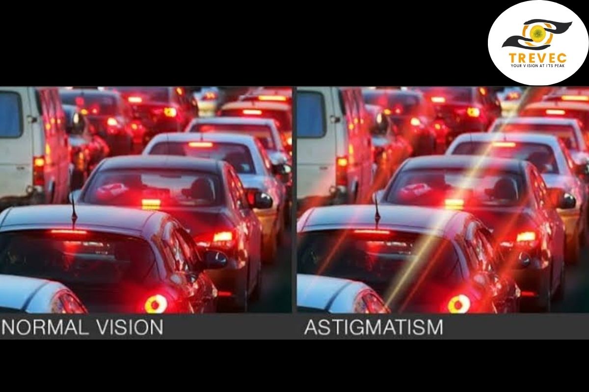 Astigmatism
