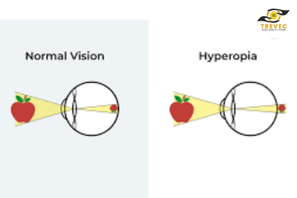 hyperopia