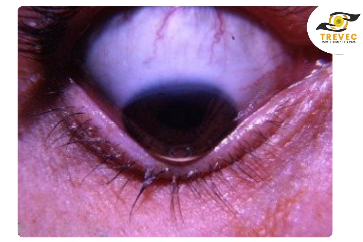keratoconus