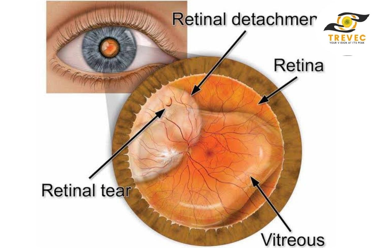 Retinal Detachment