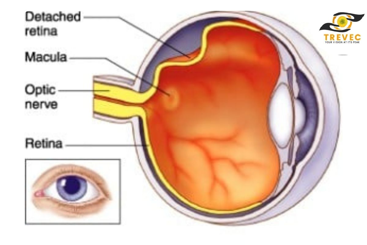 Retinal Detachment