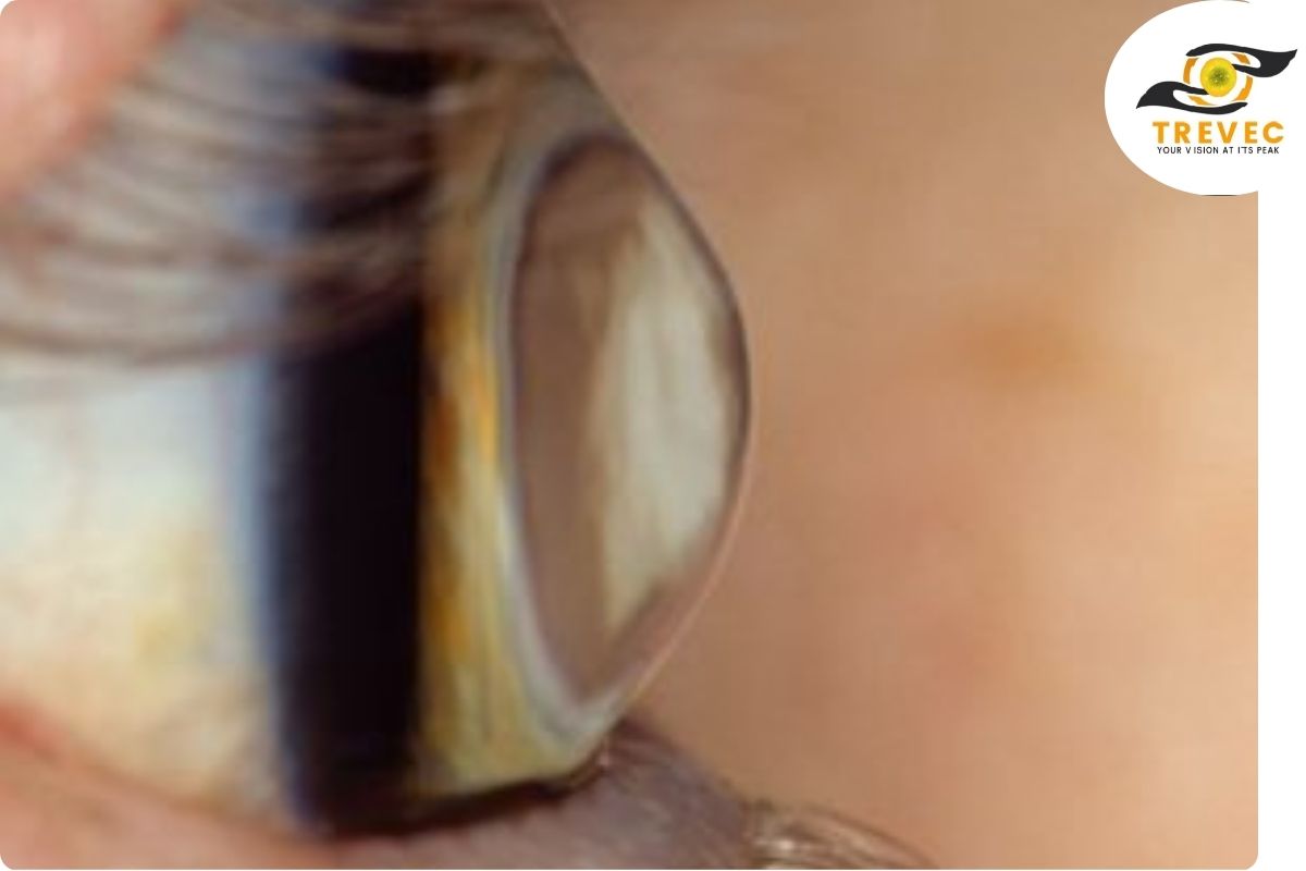 keratoconus